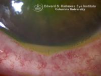 Anterior uveitis demonstrating hypopyon.